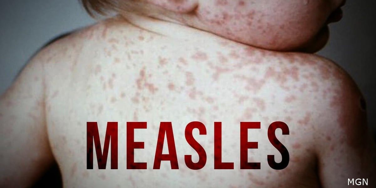 Photo : wwnytv.com Comté de Lewis : un cas de rougeole confirmé chez un résident non vacciné